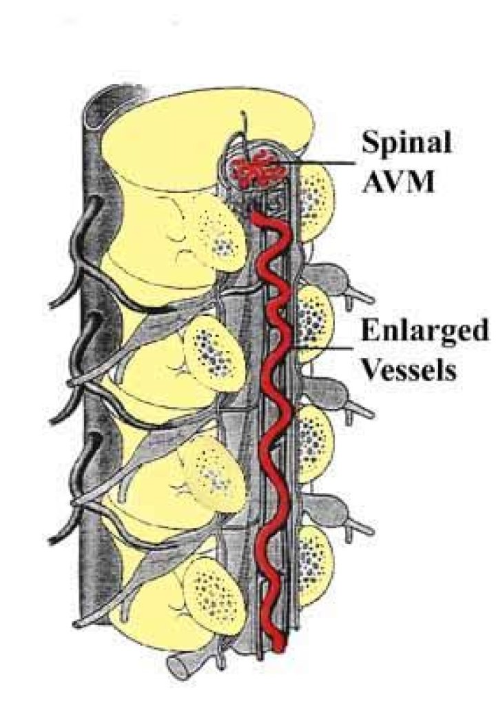 What is spinal AVM?