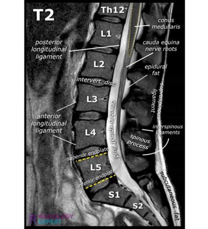 What is T2 signal in spine?