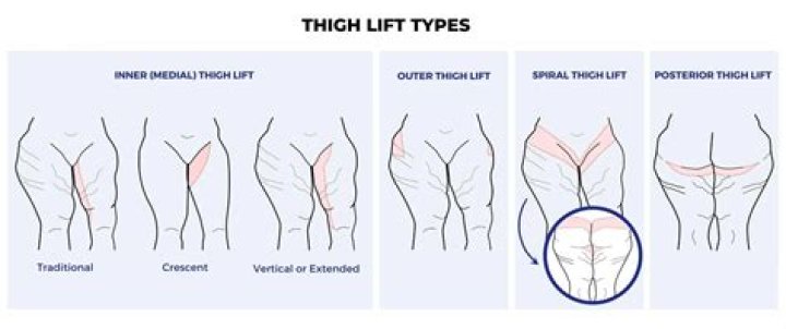 What is the average cost for a thigh lift?