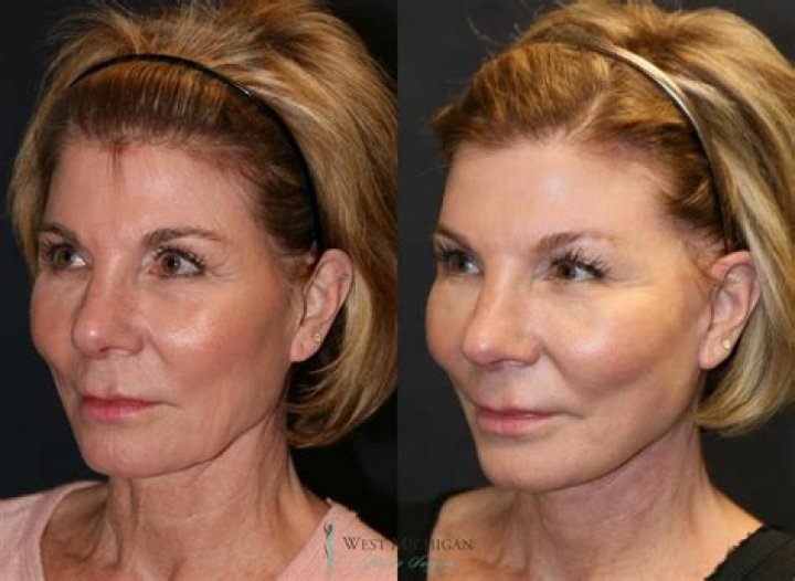 What is the average cost of a facelift in Mexico?