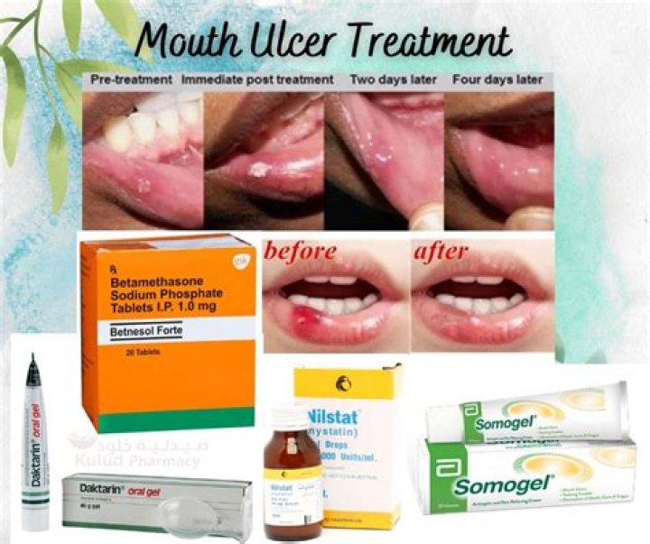 What is the best medicine for mouth sores?
