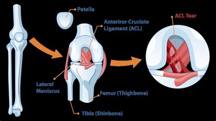 What is the most common way to tear your ACL?