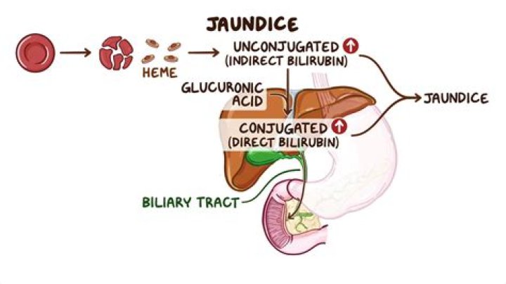 What is the pathophysiology of jaundice?