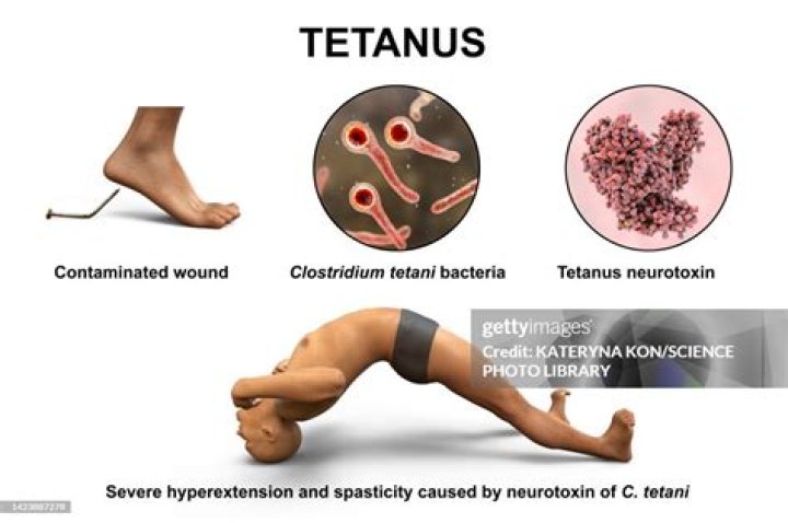 What is the pathophysiology of tetanus?