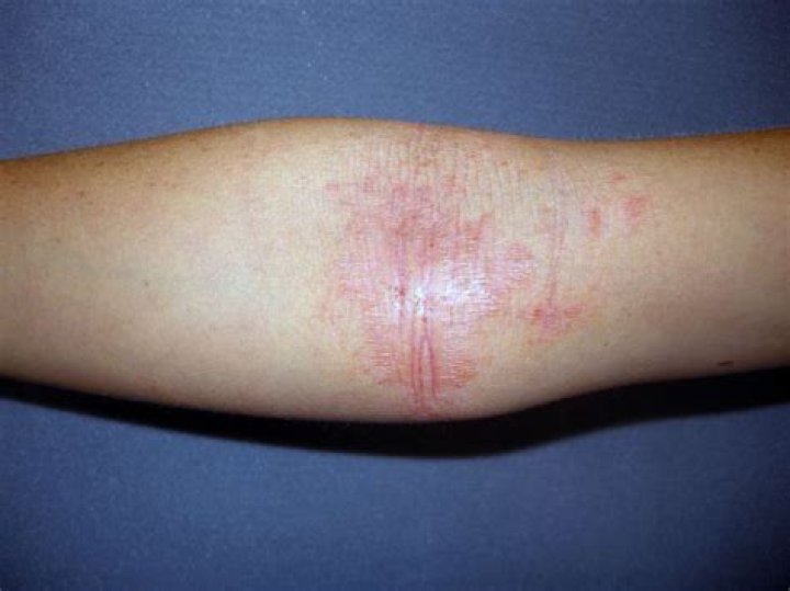 What is visible flexural dermatitis?