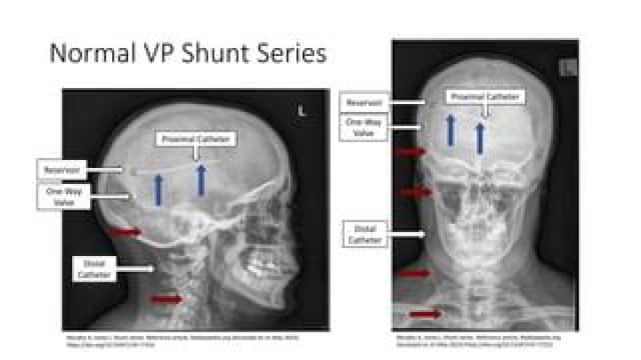 What is XRAY shunt series?