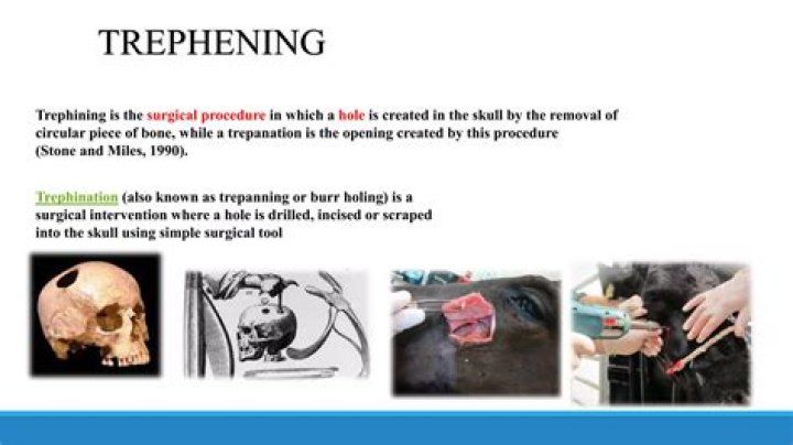 What was known as trephination?