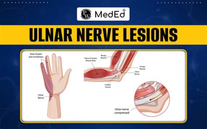 What would an injury to the ulnar nerve cause?