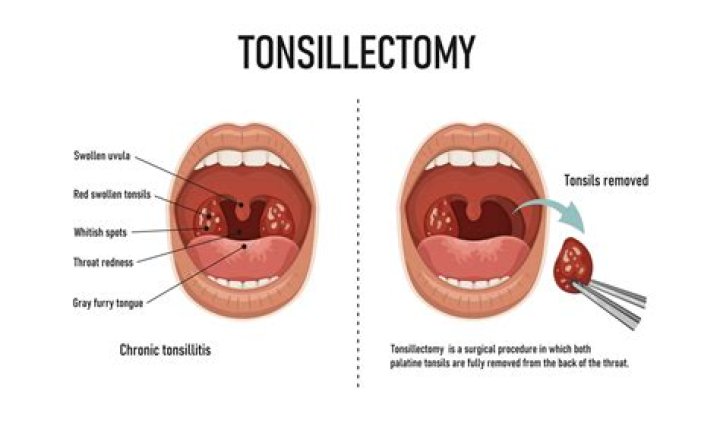 When is risk of bleeding after tonsillectomy?