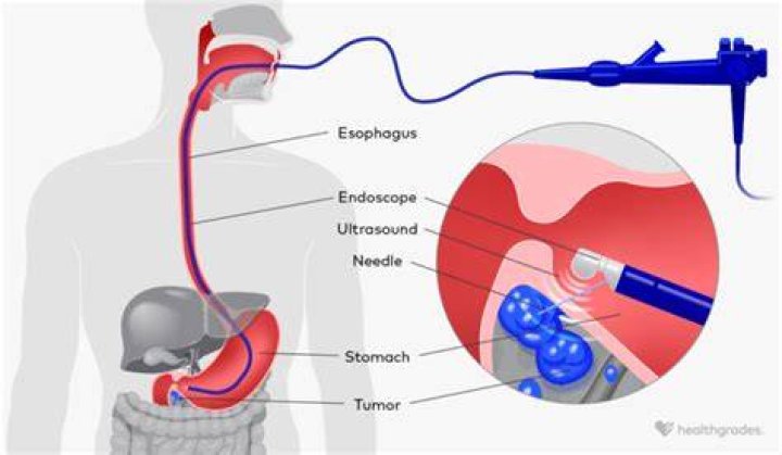 Why would a doctor order an endoscopic ultrasound?