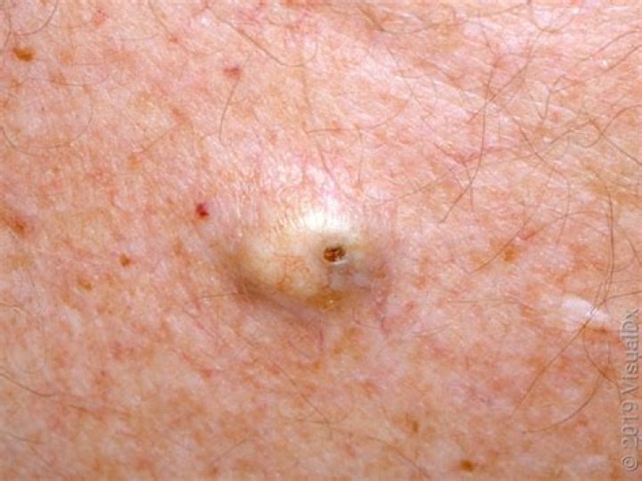 Will sebaceous cyst go away?